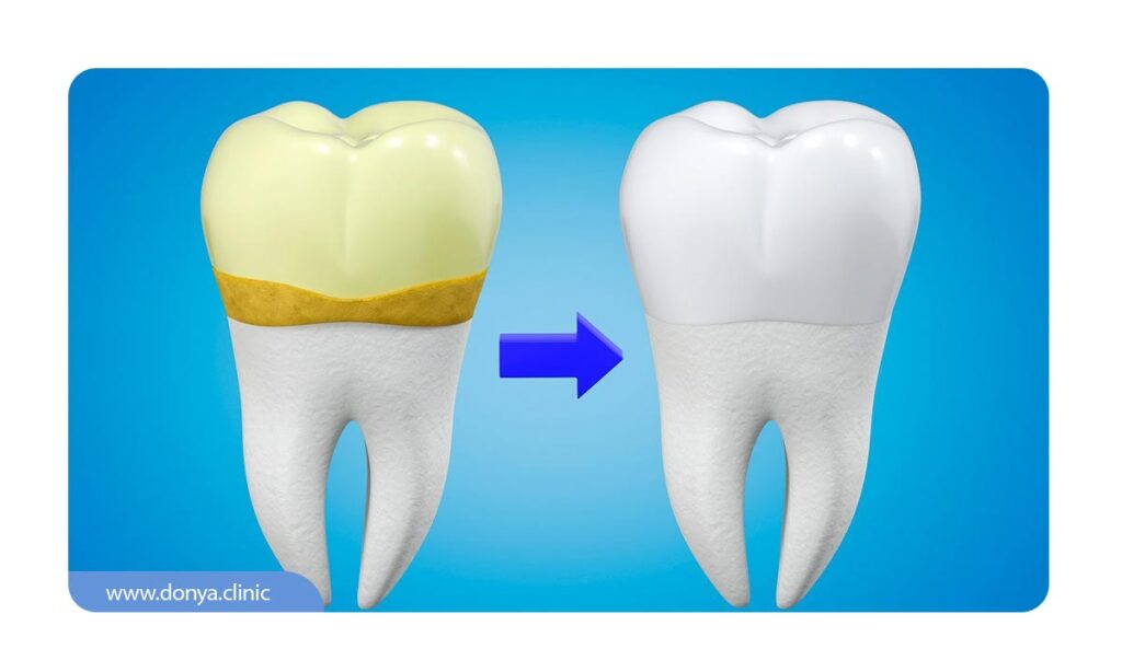 تصویر قبل و بعد از جرم گیری دندان 