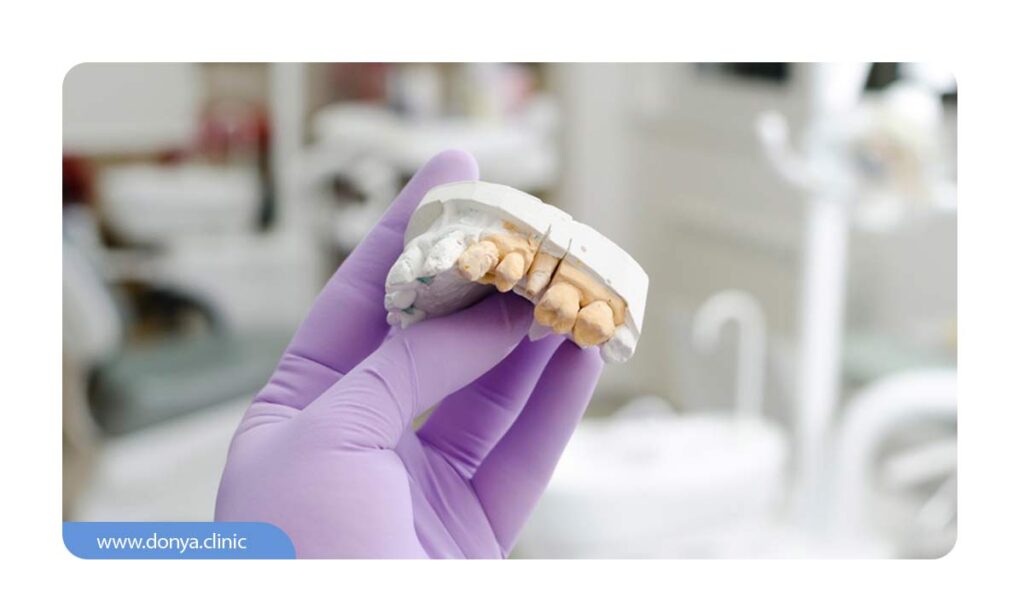 تصویر قالب دندان برای طراحی لمینت ها