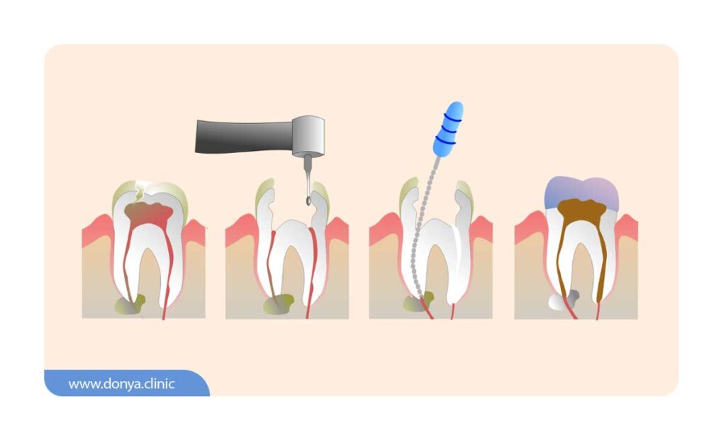 تصویر شماتیک از درمان ریشه دندان