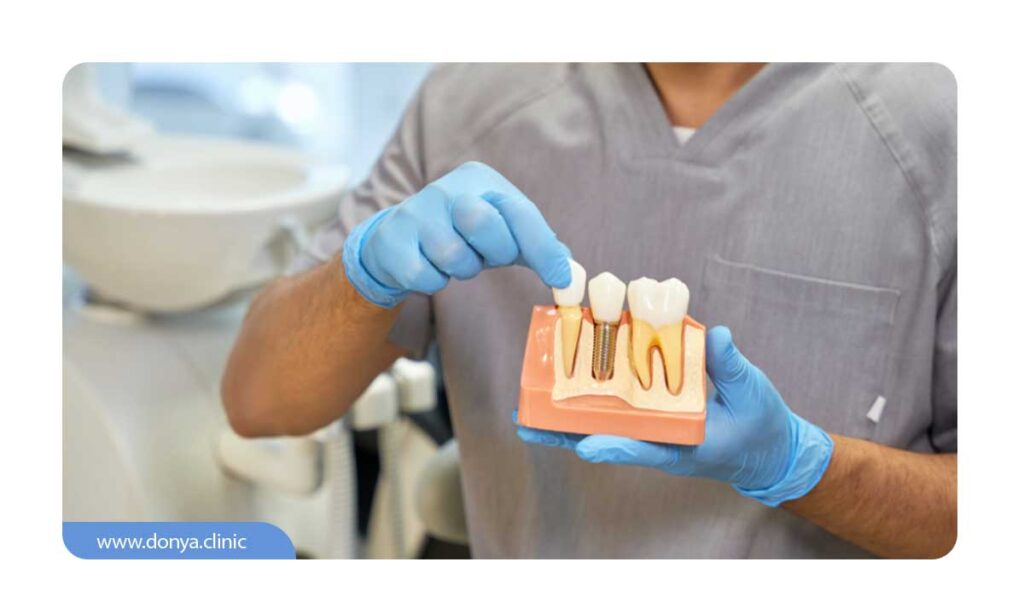 تصویر دندانپزشکی که ماکت ایمپلنت دندان را در دست دارد
