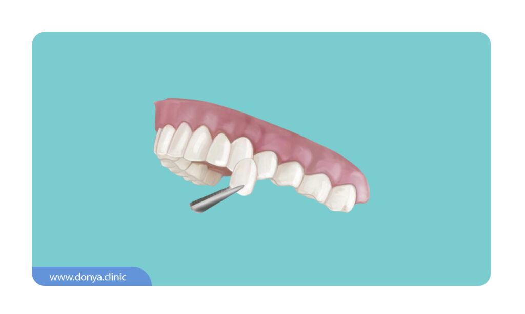 تصویر شماتیک از نصب کردن لمینت بر روی دندان