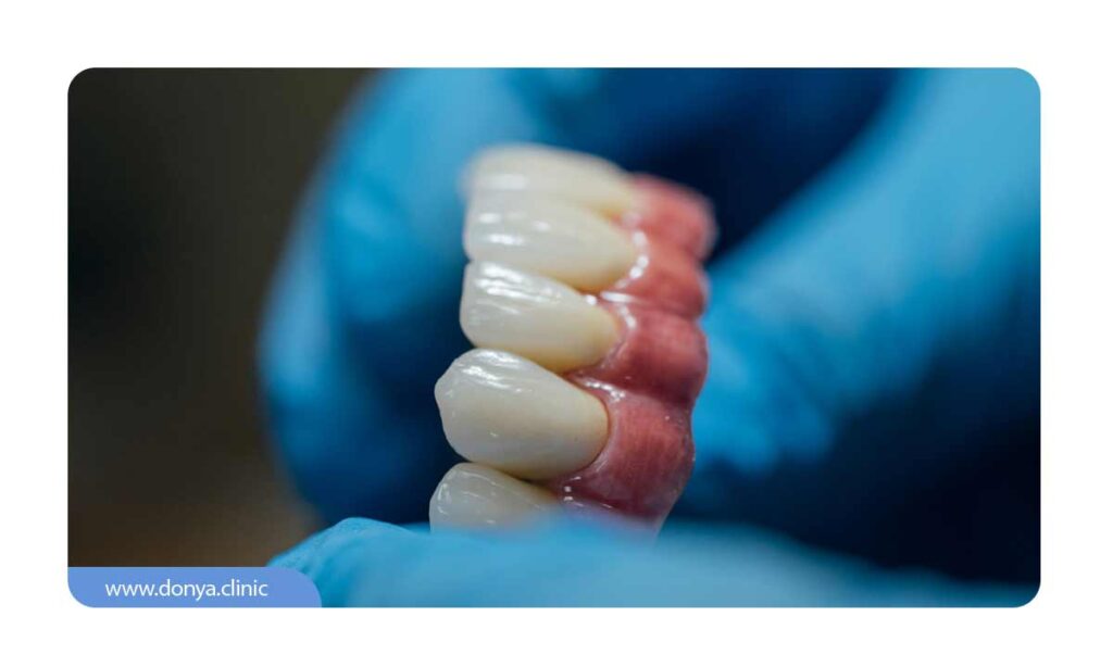 تصویر دندان مصنوعی عنوان پروتز دندان متحرک
