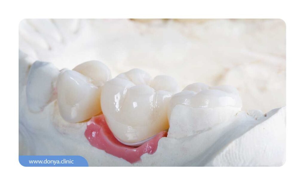 تصویر شماتیک از تاج دندان