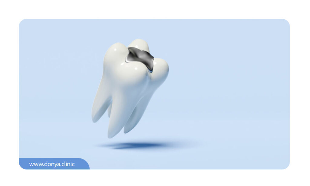 تصویر شماتیک پر کردن دندان