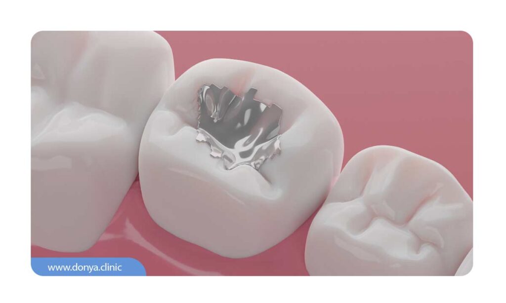 تصویر شماتیک از پر کردن دندان با مواد آمالگام