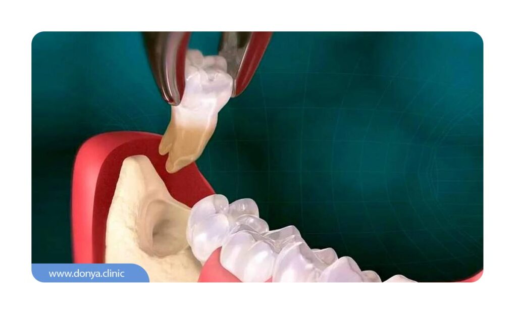 تصویر شماتیک و ساختگی از کشیدن دندان عقل