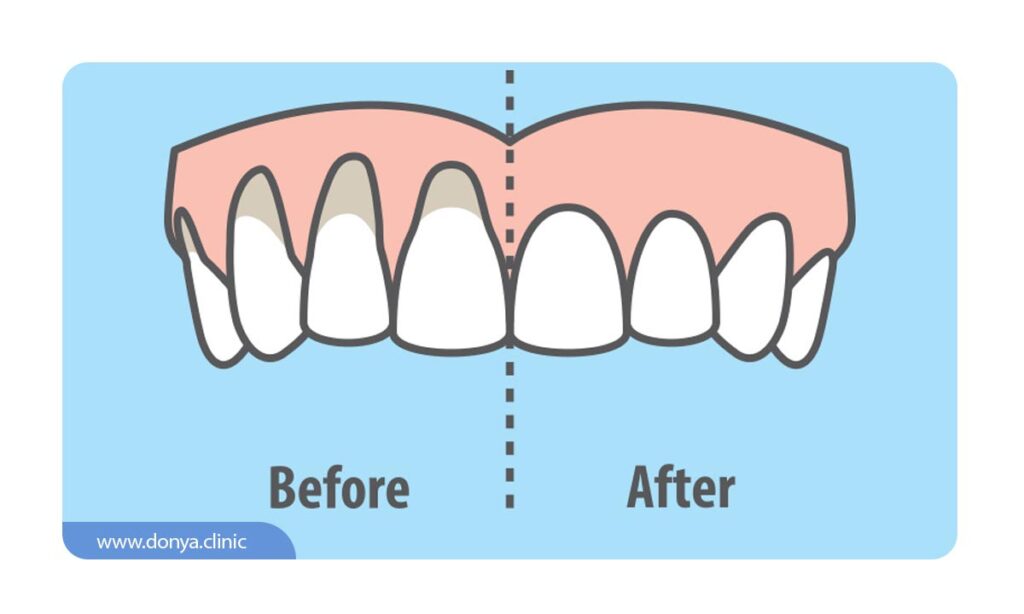 تصویر شماتیک از قبل و بعد از تحلیل لثه 