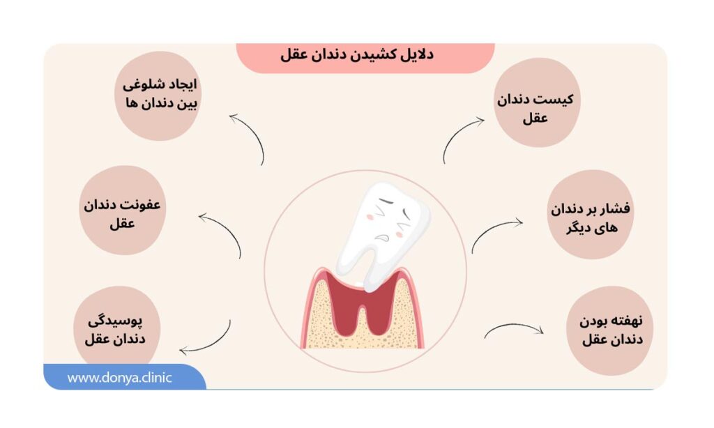 تصویر شماتیک از علت کشیدن دندان عقل 