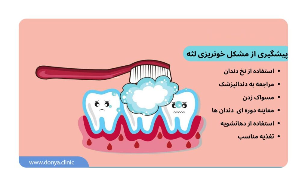 روش های پیشگیری از مشکل خونریزی لثه