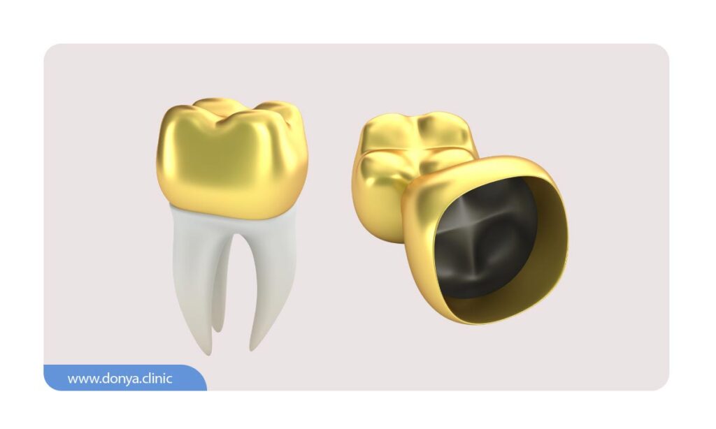 تصویر شماتیک از روکش دندان به رنگ طلایی