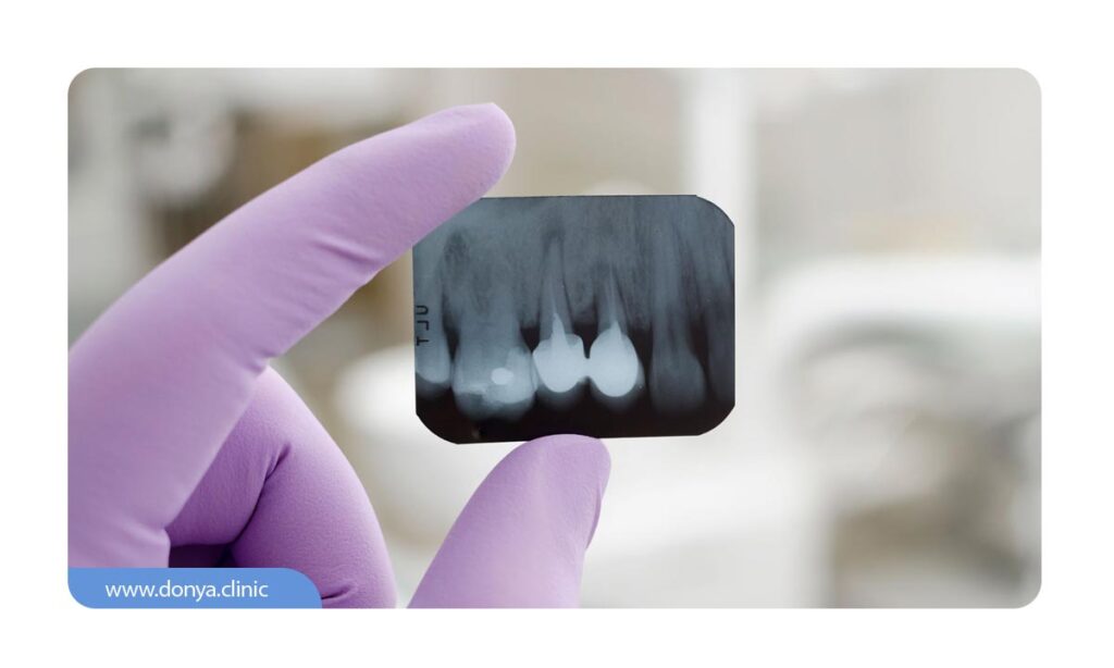 تصویر عکس رادیوگرافی دندان