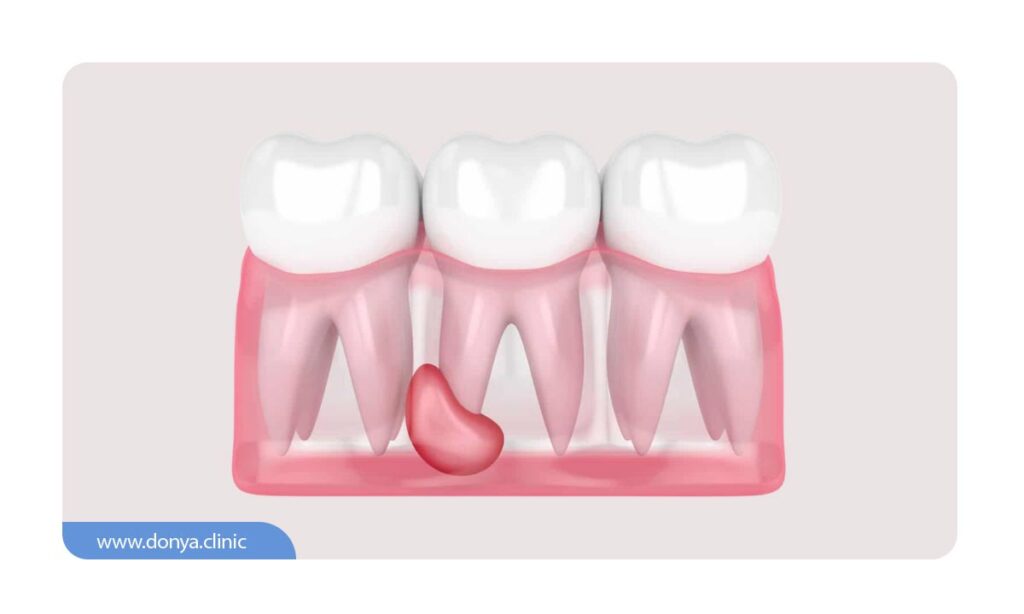 تصویر شماتیک از کیست دندان