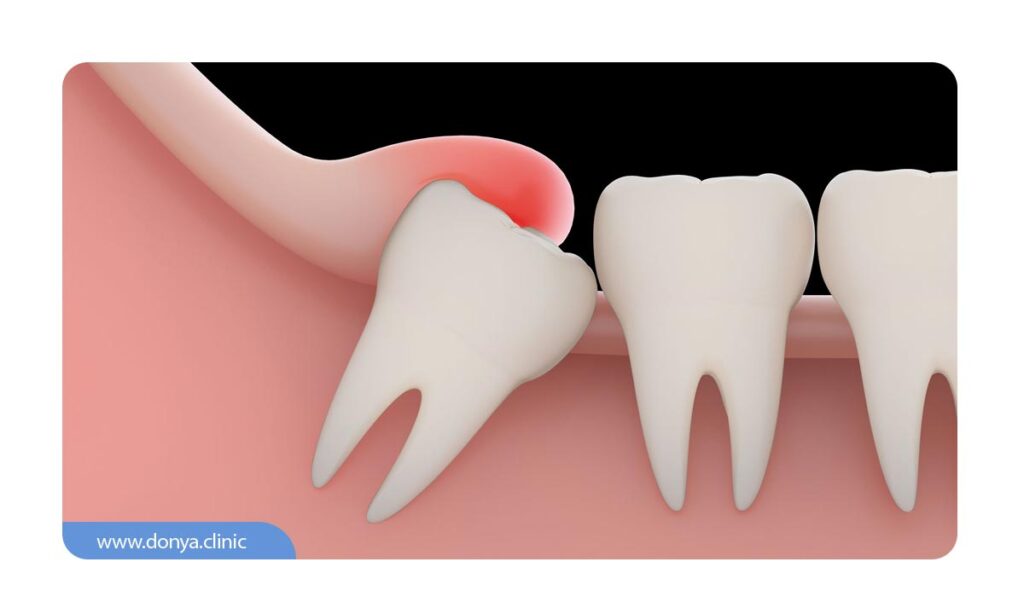 تصویر شماتیک از کیست دندان عقل