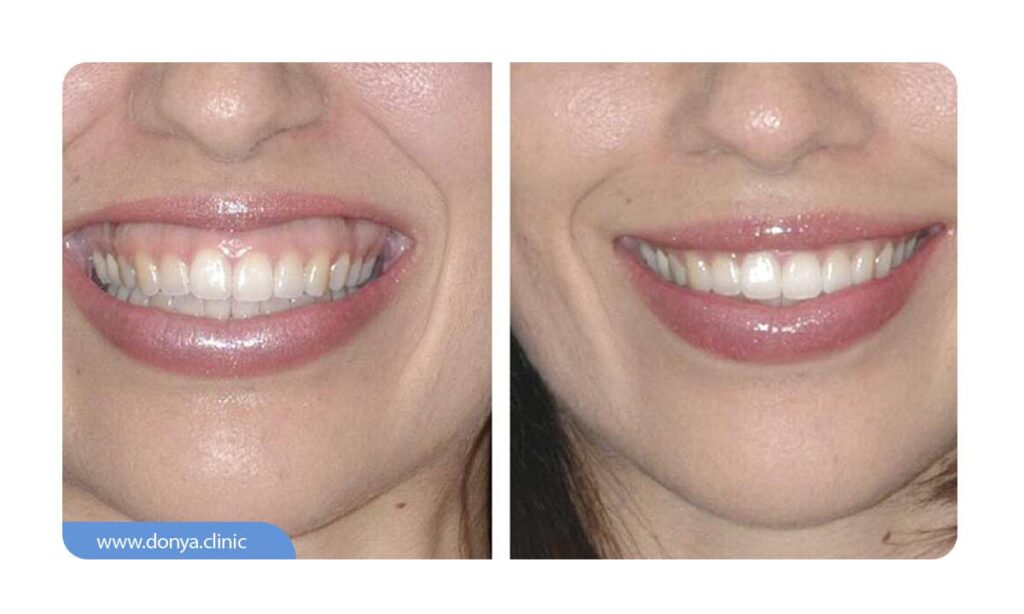 تصویر قبل و بعد از جراحی لثه برای افزایش طول تاج دندان