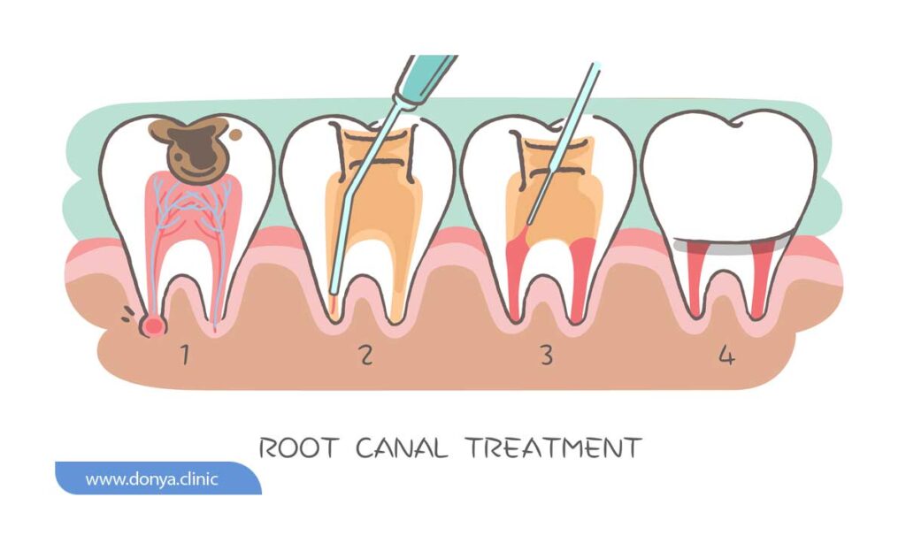 تصویر شماتیک از مراحل درمان ریشه دندان