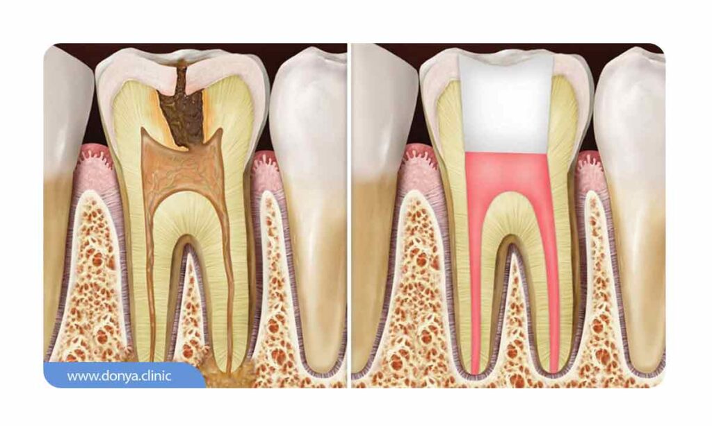 تصویر شماتیک از قبل و بعد عصب کشی دندان