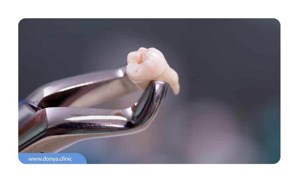 تصویر یک دندان عقل کشیده شده