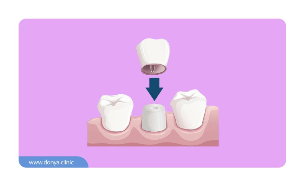 تصویر شماتیک از قرارگیری روکش تک دندان 