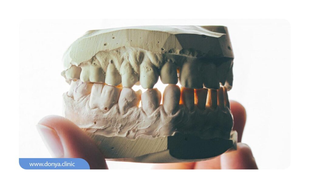 ساختار قالب گچی دندان مصنوعی 