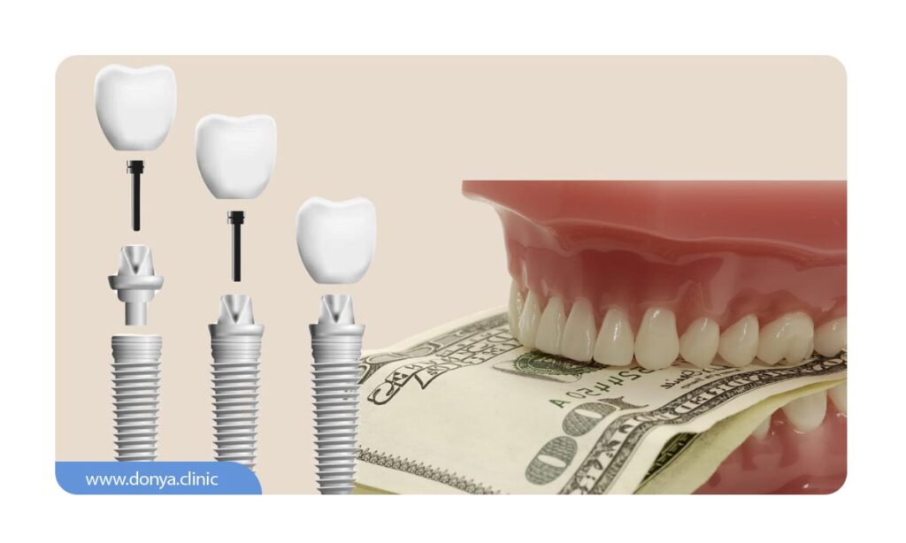 تصویر جزئیات ایمپلنت دندان و ماکن دندان که بین آن پول هزینه ایمپلنت دندان وجود دارد