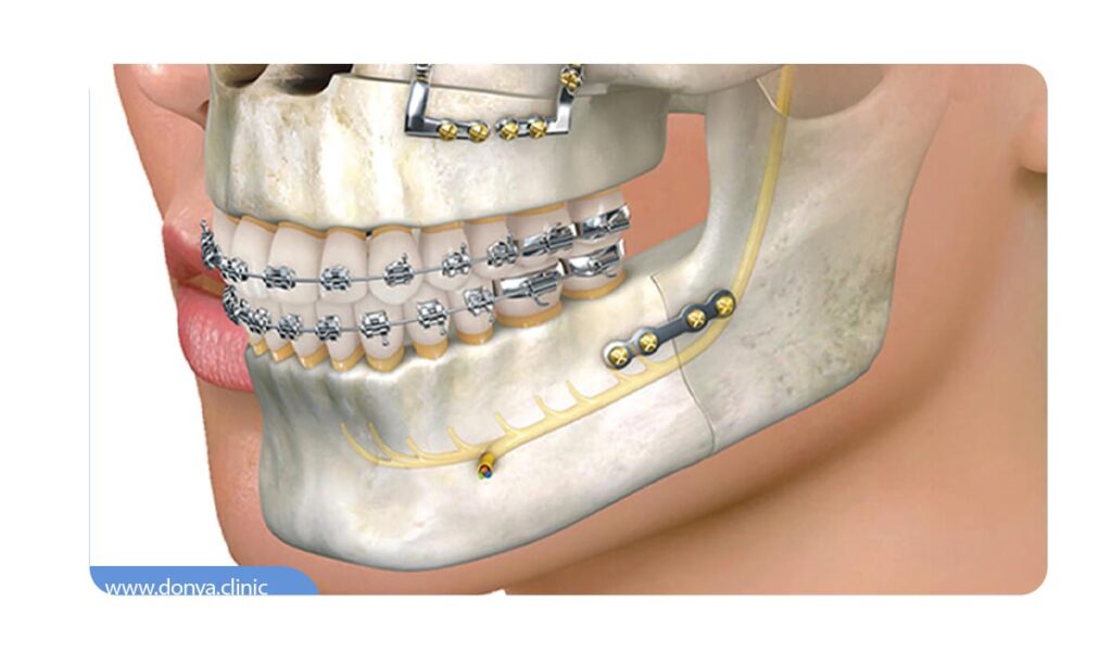 تصویر شماتیک از جراحی فک و صورت 