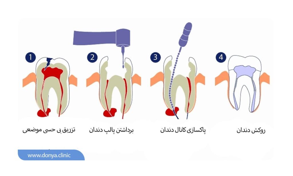 تصویر اینفوگرافیک از مراحل عصب کشی دندان