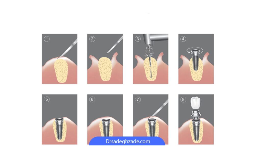 ترتیب مراحل ایمپلنت دندان جلو
