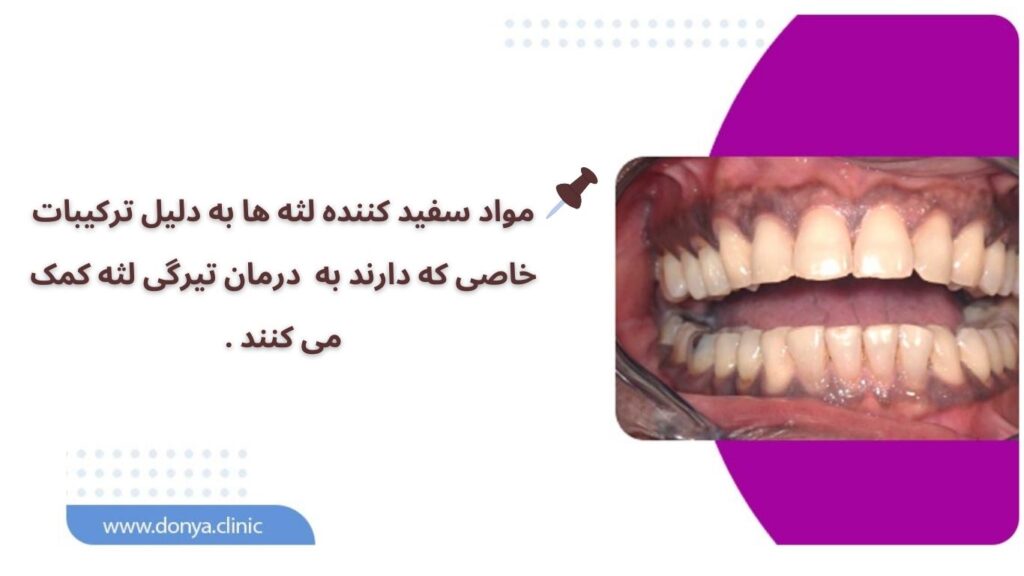 عکس اینفوگرافیک از سیاهی لثه 