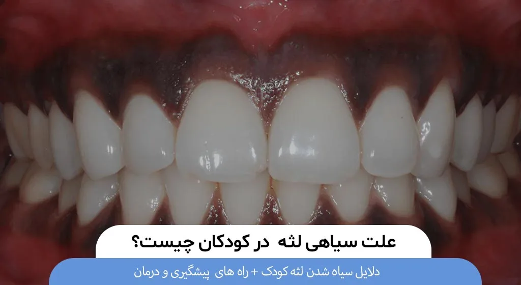 دلایل سیاهی لثه در کودکان