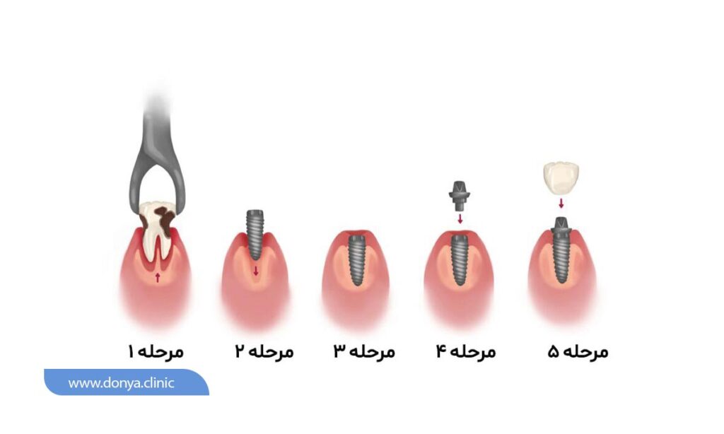 مراحل ایمپلنت دندان شامل 5 گام است که متخصص ایمپلنت آن را انجام می دهد.