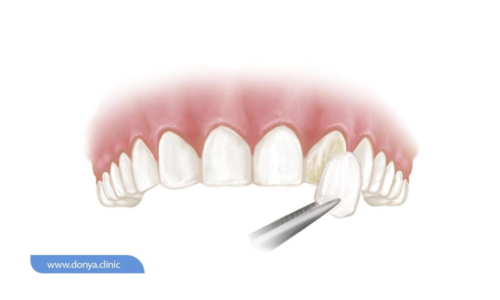 بعد از برداشتن لمینت با انجام اقداماتی دندان ها به ظاهر اولیه خود باز می گردند 