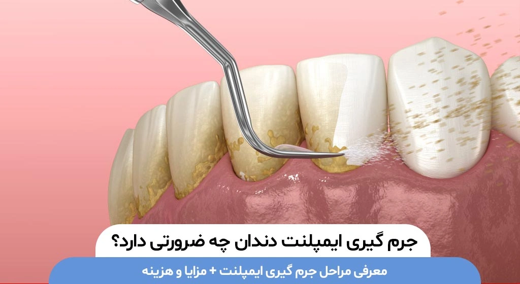 جرم گیری ایمپلنت دندان